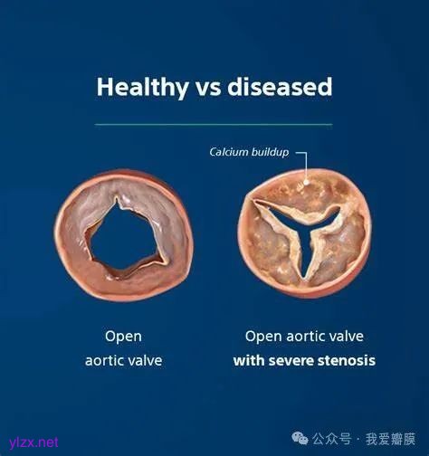 Severe Aortic Stenosis & TAVR Procedure : Treat the Heart