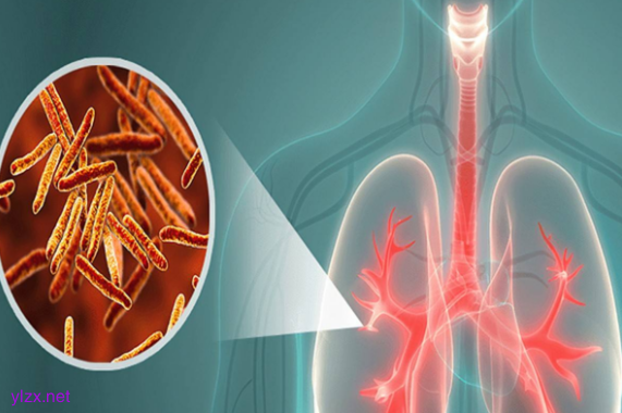 长期熬夜加班，27岁女白领同时患上多种结核病