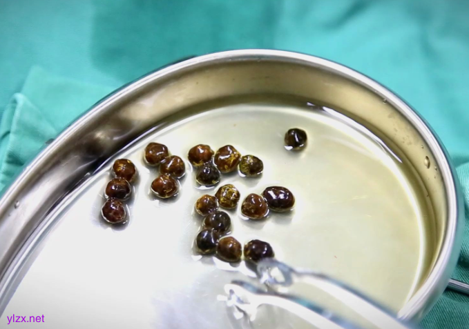 70岁老太体内暗藏125克胆结石 胆囊差点被撑爆