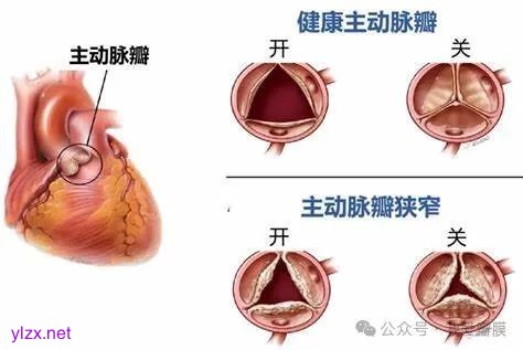 【曙光·动态】我成功实施一例经导管主动脉瓣置换术(TAVR)_澎湃号·政务_澎湃新闻-The Paper