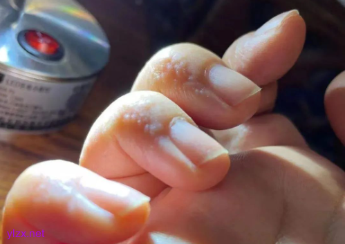 手上这种小水泡千万别挠破 多数人不知道的汗疱疹误区