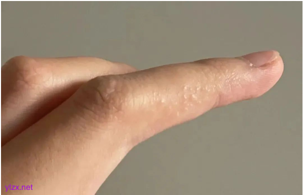 手上这种小水泡千万别挠破 多数人不知道的汗疱疹误区